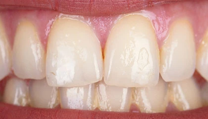 Before whitening