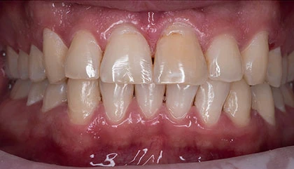 Before whitening