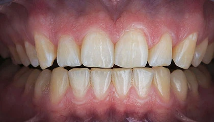 Before whitening