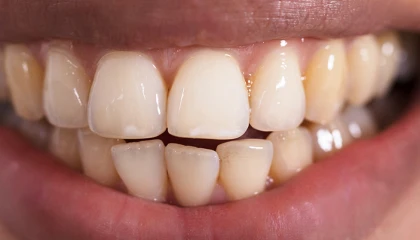 Before whitening