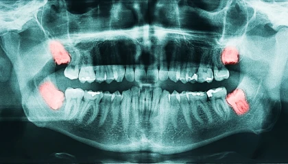 Before wisdom teeth removal